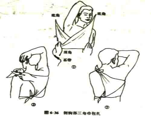 背部包扎